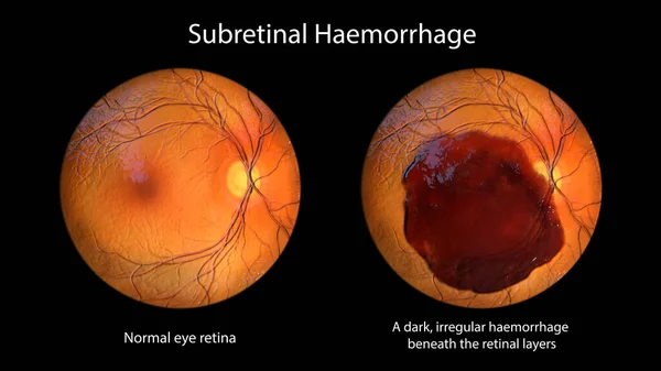 Medical Illustration Subretinal Hemorrhage Observed Ophthalmoscopy Revealing Dark Irregular Hemorrhage — Stock Photo, Image