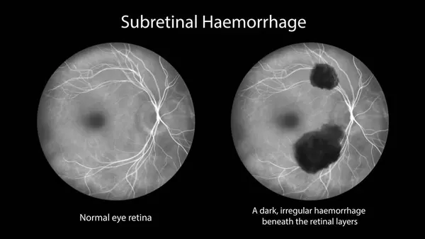 Medical Illustration Subretinal Hemorrhage Observed Fluorescein Angiography Revealing Dark Irregular — Stock Photo, Image