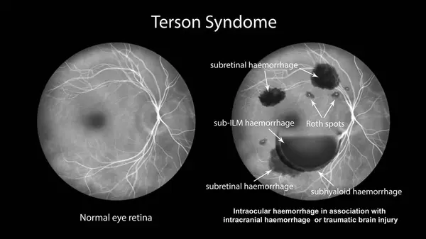 Medical Illustration Depicting Terson Syndrome Revealing Intraocular Hemorrhage Observed Fluorescein — Stock Photo, Image