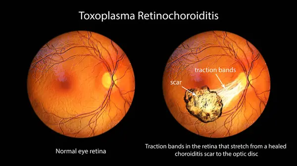Een Illustratie Van Toxoplasma Retinochoroiditis Waargenomen Tijdens Oftalmoscopie Met Tractiebanden — Stockfoto