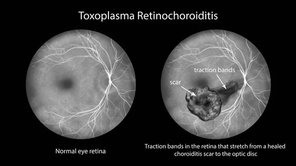 Ilustrace Znázorňující Toxoplasma Retinochoroiditidu Pozorovanou Během Fluoresceinové Angiografie Ukazující Trakční — Stock fotografie
