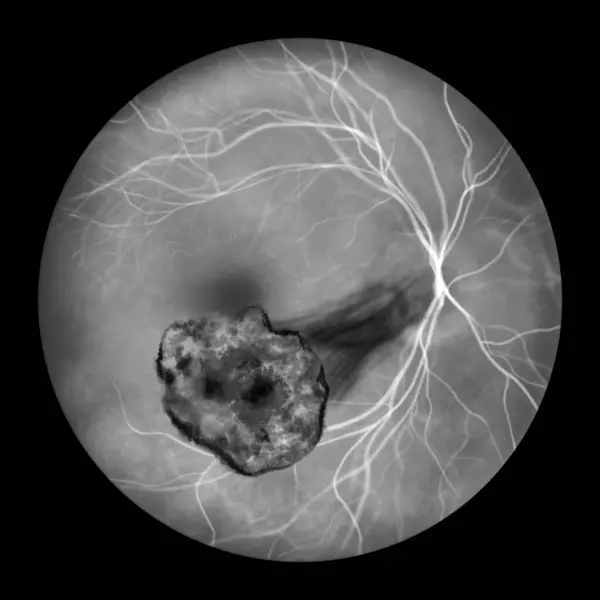 Illustration Depicting Toxoplasma Retinochoroiditis Observed Fluorescein Angiography Showcasing Traction Bands — Stock Photo, Image