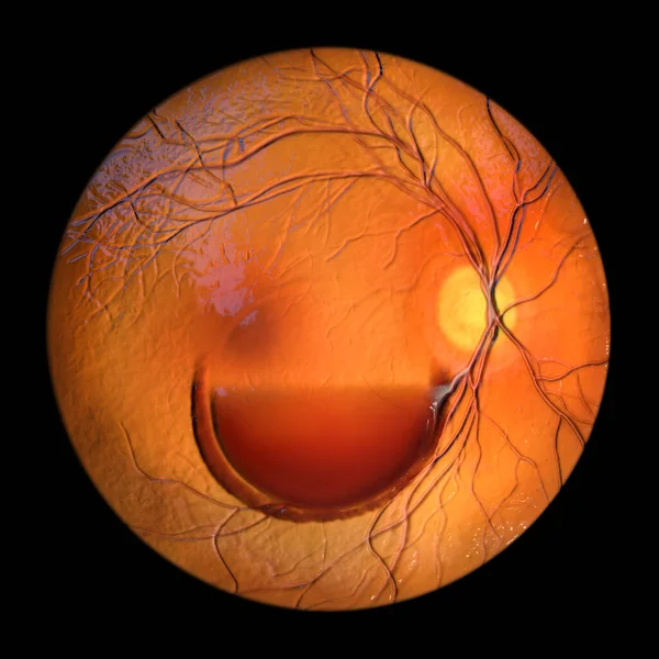 Illustration Valsalva Retinopathy Observed Ophthalmoscopy Showcasing Retinal Hemorrhages Resulting Sudden — Stock Photo, Image