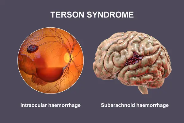 Medical Illustration Depicting Terson Syndrome Revealing Intraocular Hemorrhage Observed Ophthalmoscopy — Stock Photo, Image