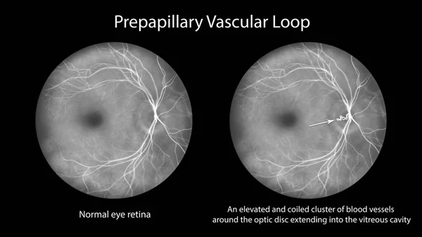 Prepapillary Vascular Loop Retina Observed Fluorescein Angiography Illustration Showcasing Looping — Stock Photo, Image
