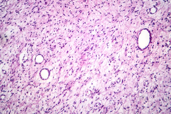 Photomicrograph of a neurofibroma tissue sample in neurofibromatosis genetic disease under a microscope, revealing spindle-shaped cells within a myxoid stroma and wavy nuclei.