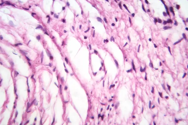 Photomicrograph of a neurofibroma tissue sample in neurofibromatosis genetic disease under a microscope, revealing spindle-shaped cells within a myxoid stroma and wavy nuclei.