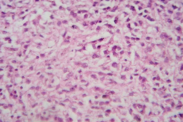 Photomicrograph of an astrocytoma, a type of brain tumor, under the microscope revealing pleomorphic astrocytic cells, prominent nuclei, and fibrillary processes.