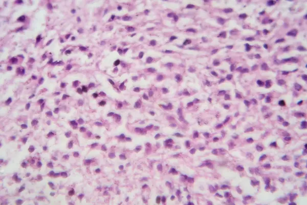 Photomicrograph of an astrocytoma, a type of brain tumor, under the microscope revealing pleomorphic astrocytic cells, prominent nuclei, and fibrillary processes.