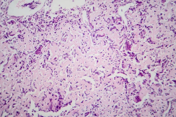 Photomicrograph of osteosarcoma, a malignant bone tumor, under the microscope revealing atypical osteoblasts producing osteoid matrix.
