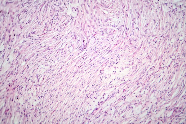 Photomicrograph of a giant cell tumor of bone, revealing numerous giant cells within a background of mononuclear cells and hemosiderin deposition.