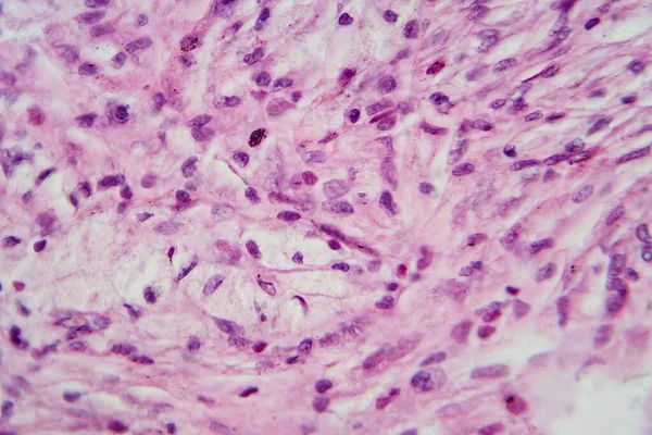 Photomicrograph Giant Cell Tumor Bone Revealing Numerous Giant Cells Background — Stock Photo, Image