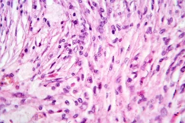 Fotomicrografía Tumor Óseo Células Gigantes Revelando Numerosas Células Gigantes Dentro — Foto de Stock