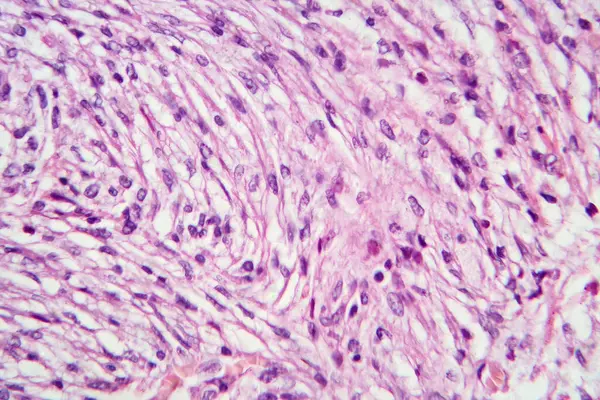 Photomicrograph of a giant cell tumor of bone, revealing numerous giant cells within a background of mononuclear cells and hemosiderin deposition.