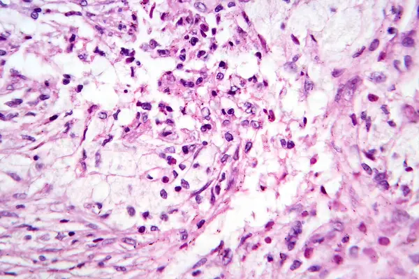 Photomicrograph Giant Cell Tumor Bone Revealing Numerous Giant Cells Background — Stock Photo, Image