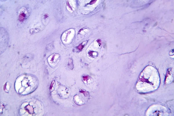 Photomicrograph Chondrosarcoma Malignant Cartilage Tumor Revealing Chondrocytes Atypical Nuclei Abundant — Stock Photo, Image