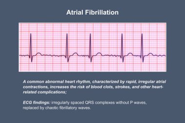 Atriyal fibrilasyonda ECG (AFib), düzensiz ritim, P dalgaları ve hızlı, kaotik atriyal aktivite içeren, çarpıntı ve felç riski oluşturan üç boyutlu bir illüstrasyon..