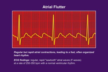 ECG in atrial flutter, an abnormal heart rhythm characterized by rapid, regular contractions of the atria. 3D illustration displaying characteristic sawtooth P-waves and irregular ventricular rhythm. clipart