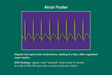 Atriyal kanat çırpmada EKG, atria 'nın düzenli kasılmalarıyla karakterize edilen anormal bir kalp ritmi. Karakteristik testere dişli P-dalgaları ve düzensiz ventriküler ritim gösteren 3D çizimler.