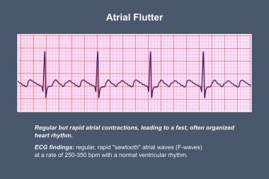 Atriyal kanat çırpmada EKG, atria 'nın düzenli kasılmalarıyla karakterize edilen anormal bir kalp ritmi. Karakteristik testere dişli P-dalgaları ve düzensiz ventriküler ritim gösteren 3D çizimler.