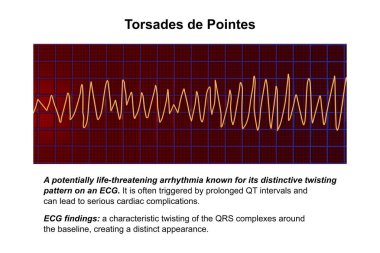 ECG göstergesi Torsades de point ritmi, tehlikeli kalp ritmi hızlı, düzensiz ritimler elektrik ekseni etrafında dönerek, potansiyel olarak bayılma veya kalp durmasına neden olur, 3D illüstrasyon.