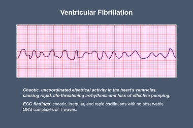 EKG, ventriküler fibrilasyonun kaotik ritmini gösteriyor. Hayati tehlike aritmisi, 3 boyutlu illüstrasyon..