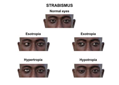 Çeşitli strabismus tiplerine sahip bir adamın 3D çizimi: esotropia, exotropia, hypertropia ve hipotropia..