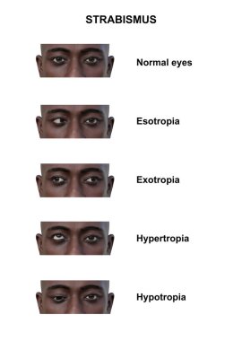 Çeşitli strabismus tiplerine sahip bir adamın 3D çizimi: esotropia, exotropia, hypertropia ve hipotropia..