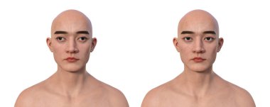 A man with exotropia and the same healthy person. 3D illustration demonstrating outward eye misalignment clipart