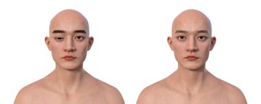 Hipotropisi olan bir adam ve aynı sağlıklı adam, 3 boyutlu illüstrasyon aşağı doğru göz hizası bozukluğu gösteriyor..