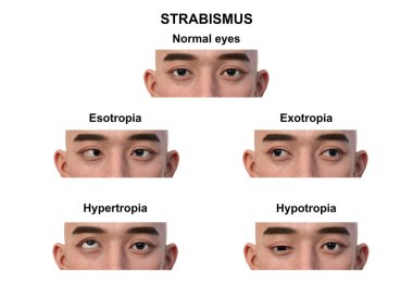 Çeşitli strabismus tiplerine sahip bir adamın 3D çizimi: esotropia, exotropia, hypertropia ve hipotropia..