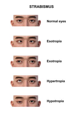 Çeşitli strabismus tiplerine sahip bir adamın 3D çizimi: esotropia, exotropia, hypertropia ve hipotropia..
