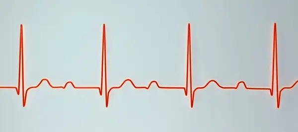 心电图显示一级房室阻滞 心脏传导紊乱的三维图像 — 图库照片