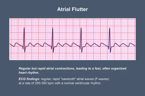心电图在心房颤动 一种以快速 有规律的心房收缩为特点的不正常的心律 3D图像显示特征锯齿P波和不规则心室节律 — 图库照片
