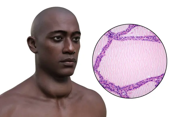 甲状腺を拡大した男性の3Dイラストと エンドミック ゴイターの影響を受ける甲状腺組織のマイクログラフ画像 — ストック写真