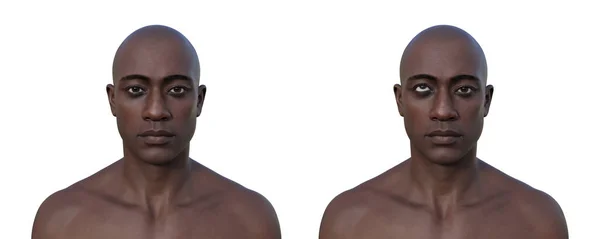 一个有高色素性的男人和一个健康的男人 3D图像显示向上的眼睛不对齐 — 图库照片