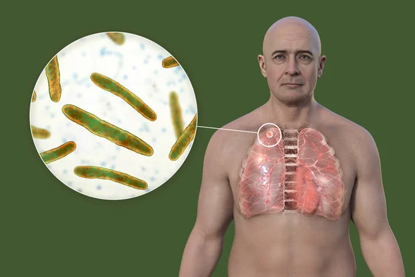 A man with transparent skin revealing the lungs affected by secondary tuberculosis and close-up view of Mycobacterium tuberculosis bacteria, 3D illustration.