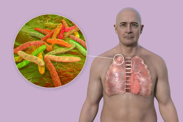 A man with transparent skin revealing the lungs affected by secondary tuberculosis and close-up view of Mycobacterium tuberculosis bacteria, 3D illustration.