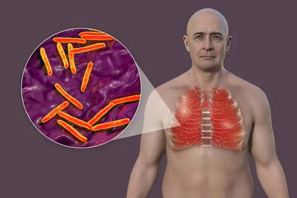 A 3D illustration showcasing the upper half part of a man with transparent skin, revealing the lungs affected by miliary tuberculosis, and close-up view of Mycobacterium tuberculosis bacteria.