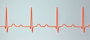 ECG 'nin 3D görüntülemesi 1. derece AV bloğu, kardiyak iletim bozukluğu