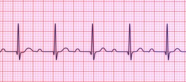 ECG 'nin 3D görüntülemesi 1. derece AV bloğu, kardiyak iletim bozukluğu