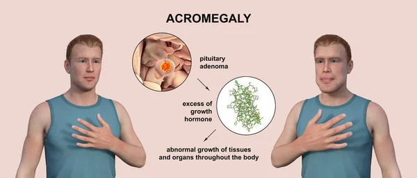 stock image Acromegaly, 3D illustration showing an increase in the size of the hands and face due to overproduction of somatotrophin caused by a tumor of the pituitary gland.