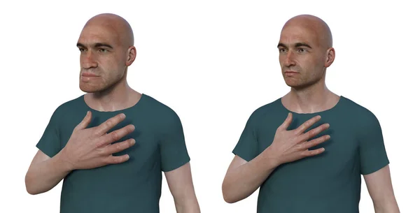 Stock image Acromegaly in a man, and the same healthy man. 3D illustration showing an increase in the size of the hands and face due to overproduction of somatotrophin caused by a tumour of the pituitary gland.