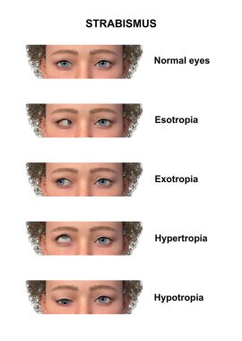Çeşitli strabismus tiplerine sahip bir çocuğun notlu 3D çizimi: esotropia, exotropia, hypertropia ve hipotropia.