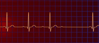 AV bloğu (Wenckebach) olan bir ECG 'yi 3D görselleştirme, kalp ritmindeki anormal elektrik iletimini vurguluyor.
