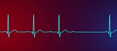 AV bloğu (Wenckebach) olan bir ECG 'yi 3D görselleştirme, kalp ritmindeki anormal elektrik iletimini vurguluyor.