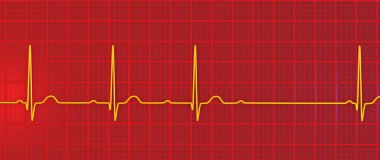 AV bloğu (Wenckebach) olan bir ECG 'yi 3D görselleştirme, kalp ritmindeki anormal elektrik iletimini vurguluyor.