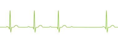 AV bloğu (Wenckebach) olan bir ECG 'yi 3D görselleştirme, kalp ritmindeki anormal elektrik iletimini vurguluyor.