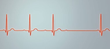 AV bloğu (Wenckebach) olan bir ECG 'yi 3D görselleştirme, kalp ritmindeki anormal elektrik iletimini vurguluyor.