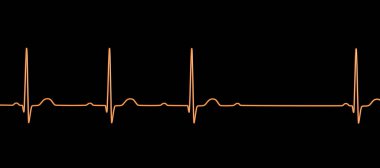 AV bloğu (Wenckebach) olan bir ECG 'yi 3D görselleştirme, kalp ritmindeki anormal elektrik iletimini vurguluyor.